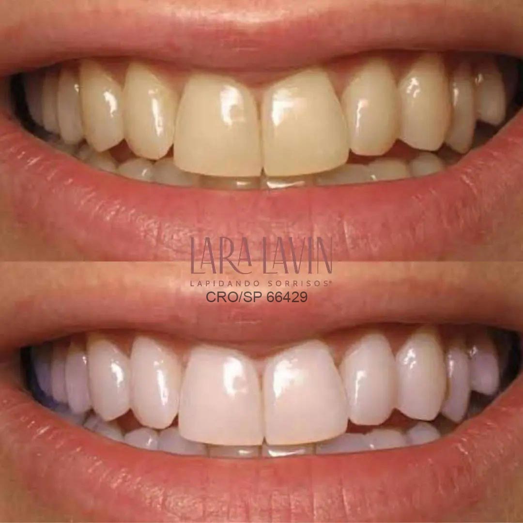 Clareamento dentário a laser