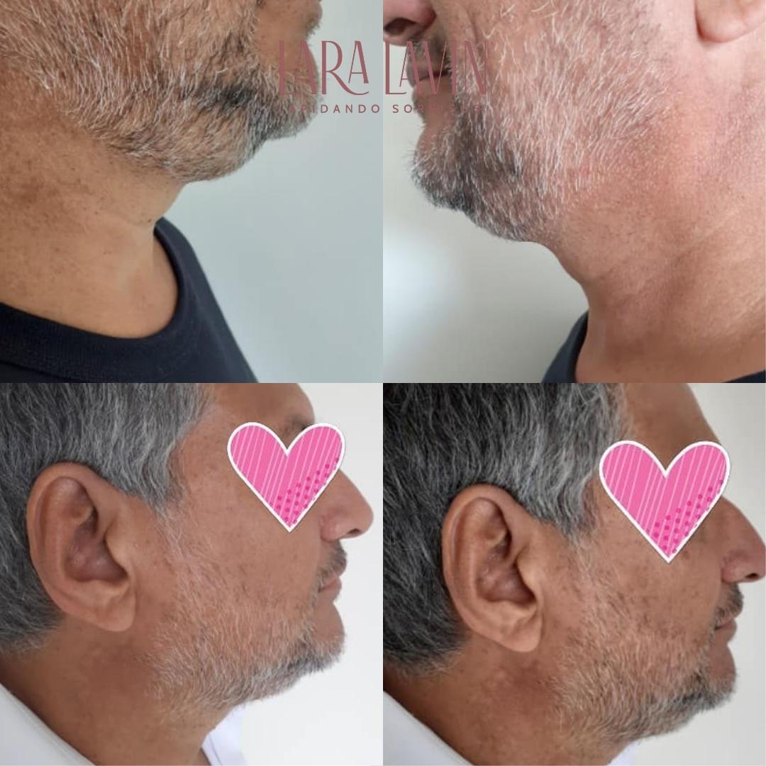 Lipo de Papada
