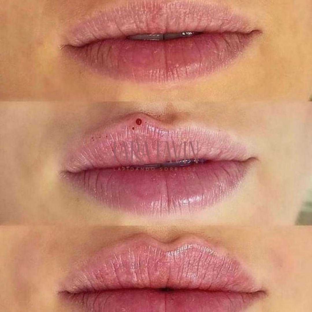 Preenchimento labial