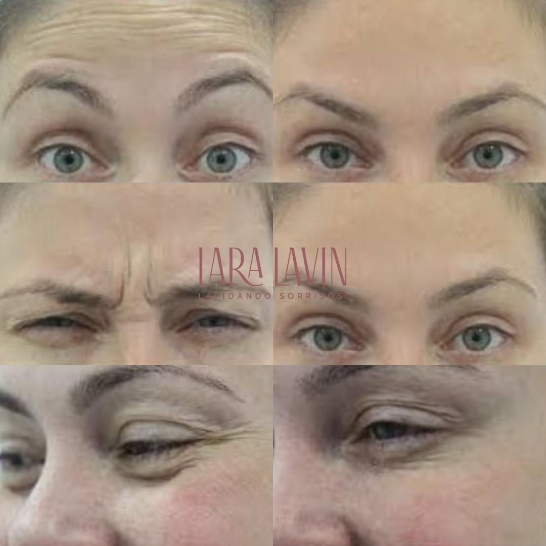 Tratamento com Toxina Botulínica
