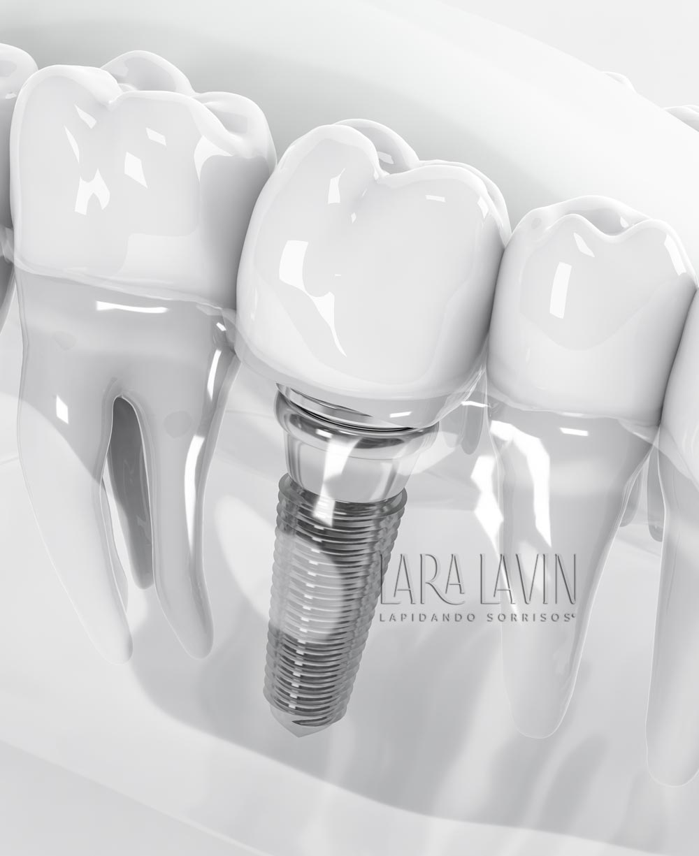 Implante Dentário